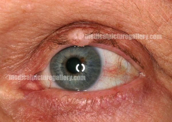 Nevus of palpebral conjunctiva