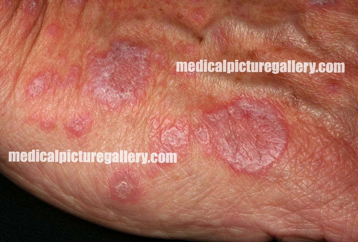 Lichenoid dermatitis