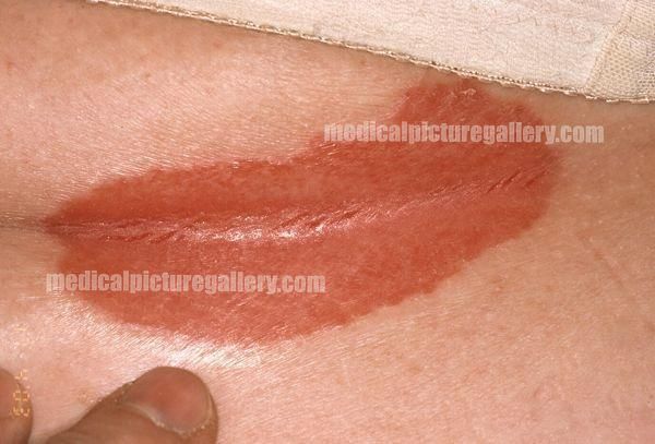 Psoriasis inversa