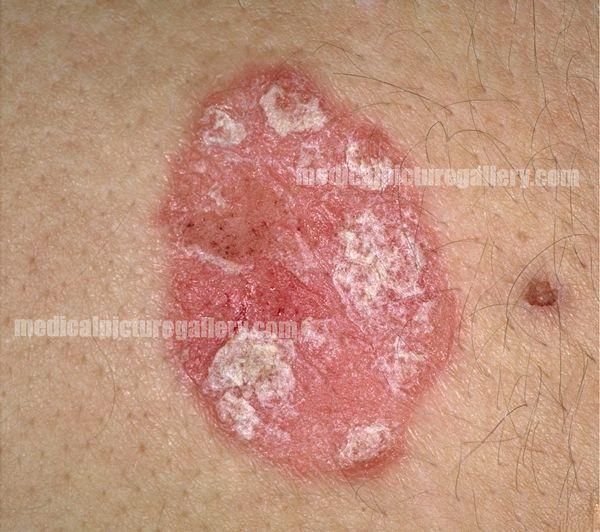 Psoriasis miscellaneous