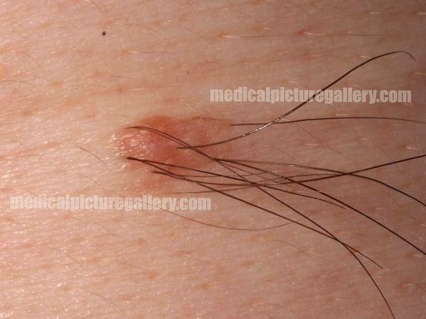 Intradermal melanocytic nevus