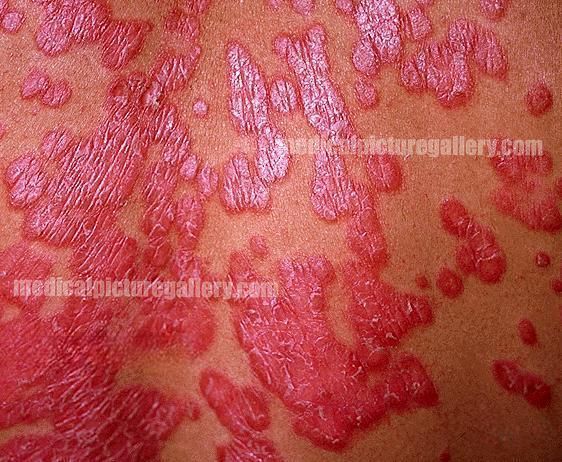 Psoriasis vulgaris