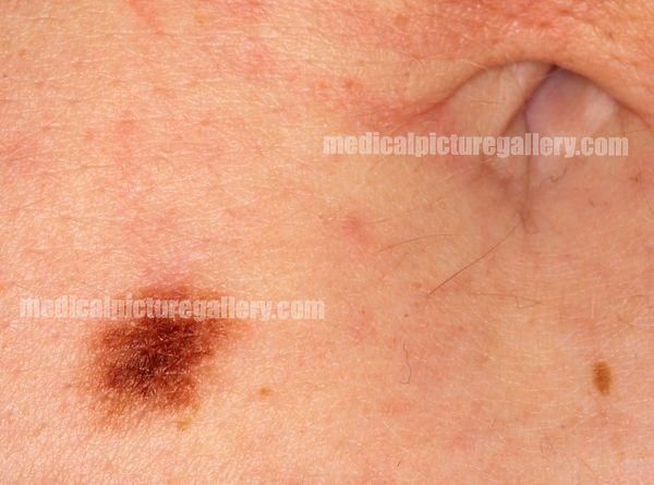 Junctional nevus
