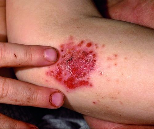 Eczema nummulare
